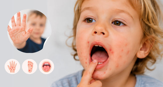 Hand-Fuß-Mund-Krankheit: Symptome erkennen, Ansteckung vermeiden und Beschwerden lindern